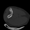 SPORK, NICO - 22.03.1976 - 02.08.2022 - CT obere Extremität - 17:51:17